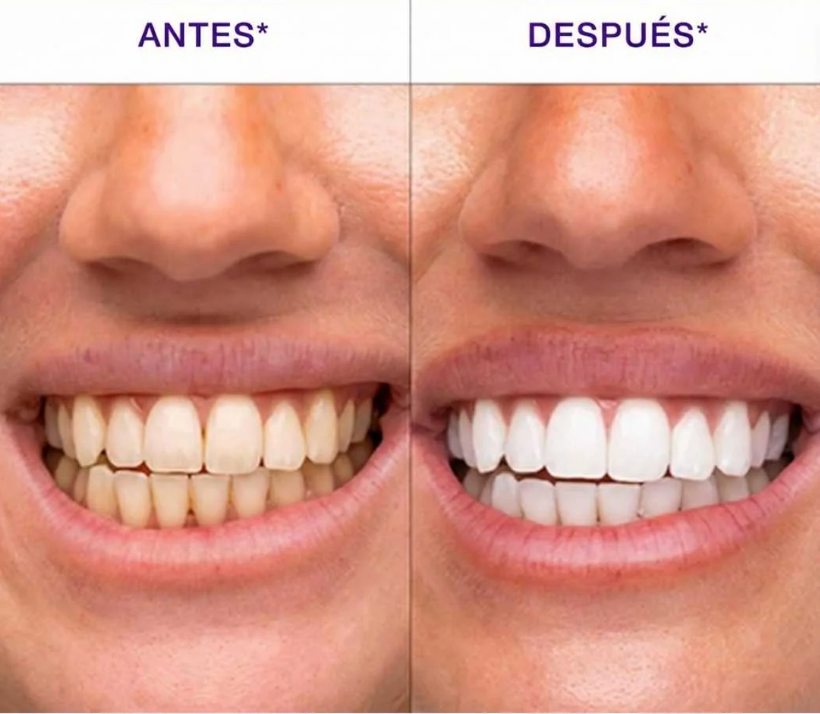 Tiras Blanqueadoras Dentales // Efecto Rapido